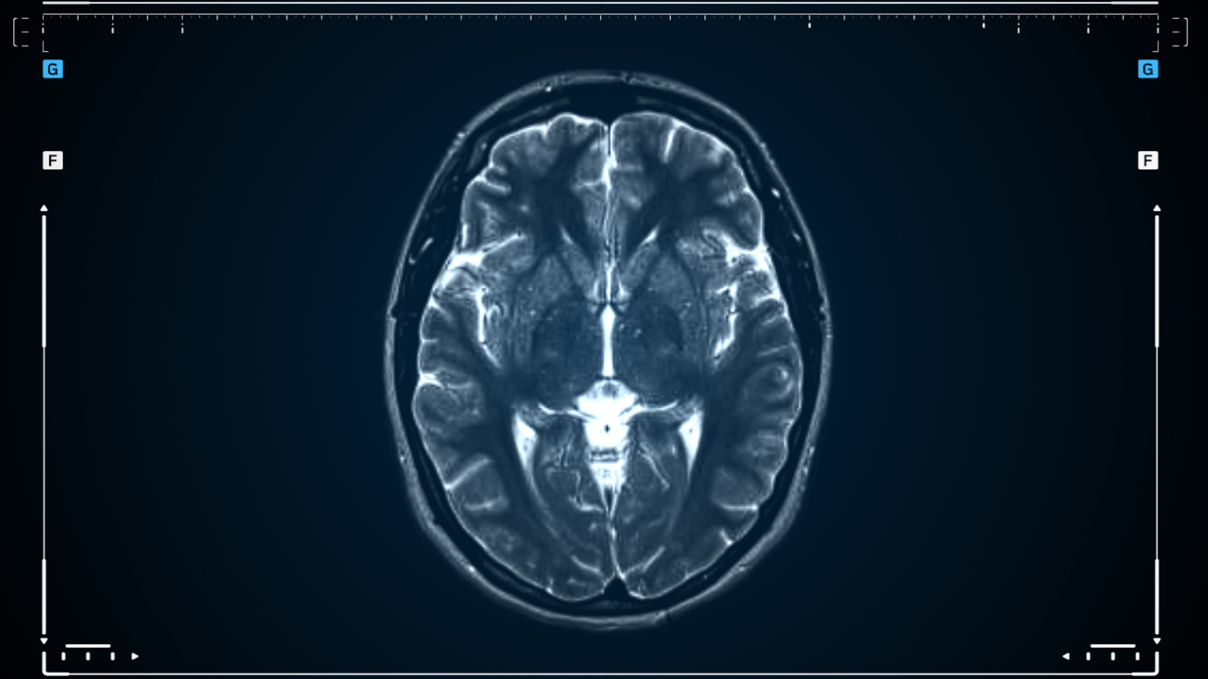 MRI brain scan